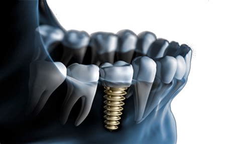 implante dentário - implante capilar preço